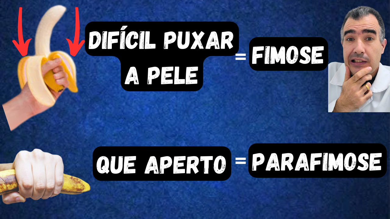 FIMOSE E PARAFIMOSE entenda suas diferenças Dr Lucas Felipe Gomes Urologista