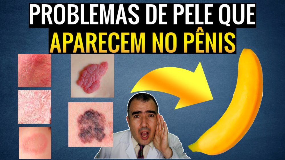 Problemas de pele na região genital causas diagnóstico e tratamento Dr Lucas Felipe Gomes