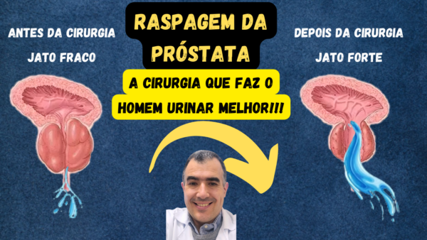 RASPAGEM DA PRÓSTATA: a cirurgia que faz o homem urinar melhor. - Dr ...