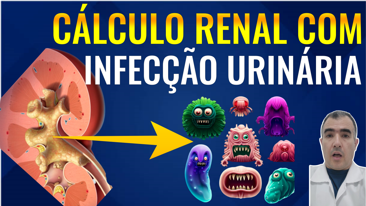 Cálculo renal com infecção urinária só o antibiótico não vai resolver