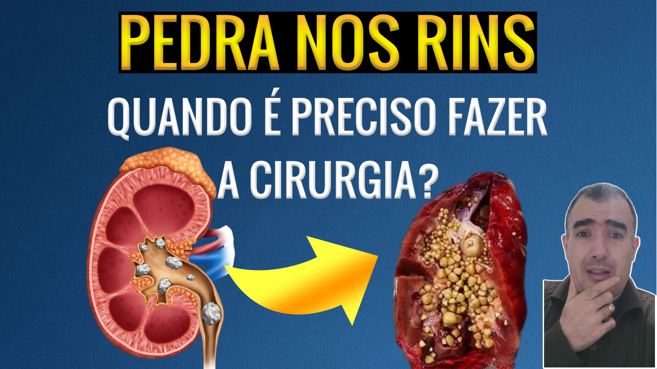 Como Prevenir Pedras Nos Rins Cirurgia Para Pedra Nos Rins: Quando