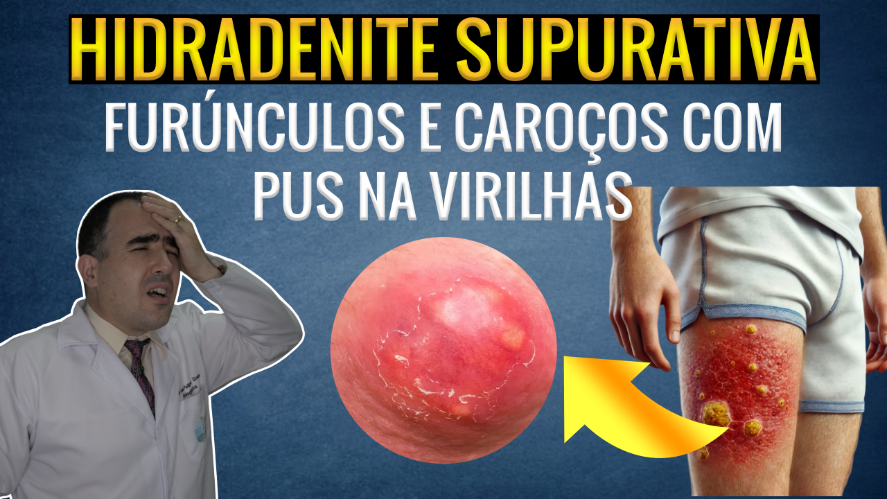 Entendendo a Hidradenite Supurativa: Uma Visão Completa - Dr. Lucas ...